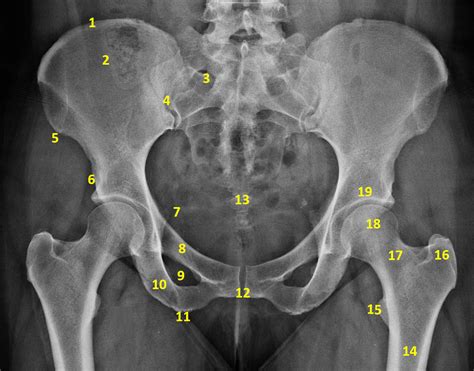 Pelvic Bone Anatomy Radiology Pelvis Annotated Frontal Projection My