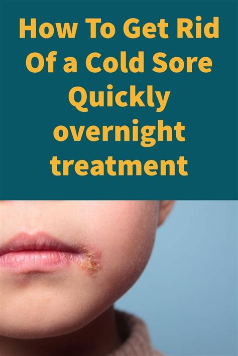 How To Get Rid Of A Cold Sore Quickly Cold Sores Can Be A Major