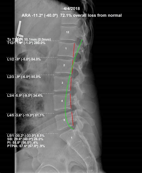 Chiropractic Biophysics Optimus Spine And Posture Dr Gareth Bury