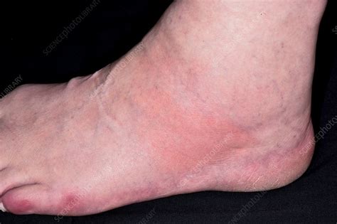 Swollen Ankle In Gout Stock Image C0345438 Science Photo Library