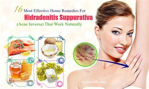 16 Effective Home Remedies For Hidradenitis Suppurativa That Work
