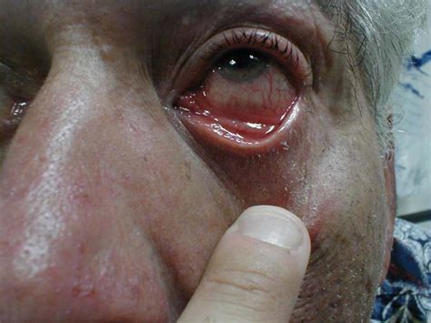 Conjunctivitis Physical Examination Wikidoc