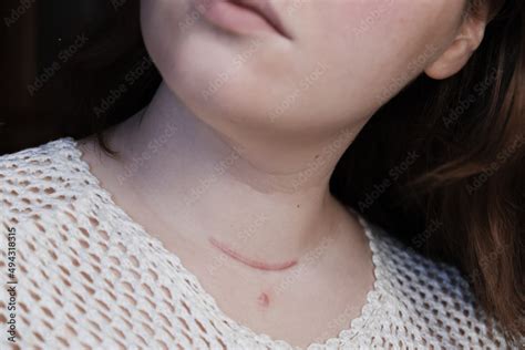 Scar On The Neck Surgical Wounds Removal Of Tumor And Thyroid Cancer