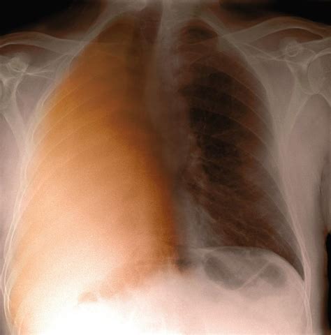 Lung Cancer X Ray Photograph By Du Cane Medical Imaging Ltd