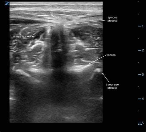 Lumbar Puncture Sonoguide