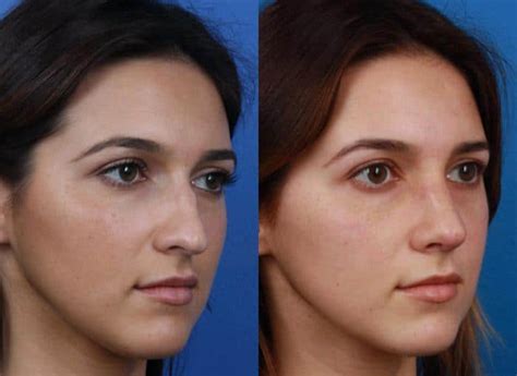 Best Rhinoplasty And Nose Jobs In New York City Ny Dr Philip Miller