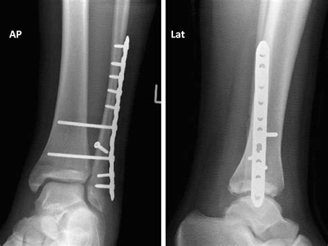 Acutely Irreducible Ankle Fracture Dislocation A Report Of A Bosworth