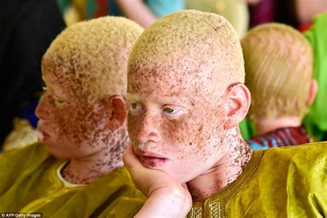 Albinos Around World Gather For International Albinism Awareness Day Big World Tale