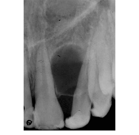 Periapical Radiography Before Therapy Unicystic Radiolucent Lesion