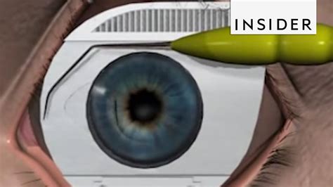 How Does LASIK Correct Vision Videos