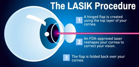 What Is Laser Eye Surgery And Who Can Have It