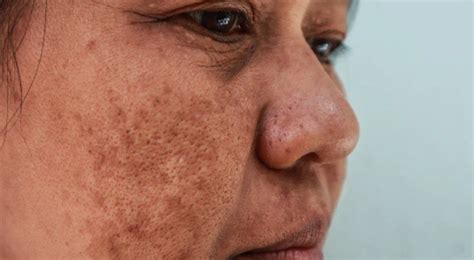 How Is Melasma Treated During Pregnancy Cary Obgyn