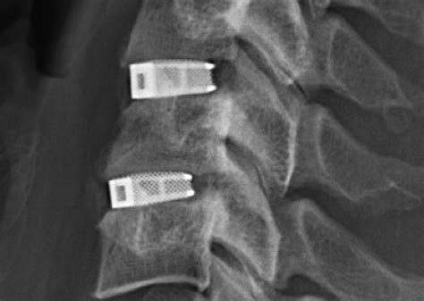 Fda Clears First Ever 3d Printed Spine Implant To Treat Of Multiple