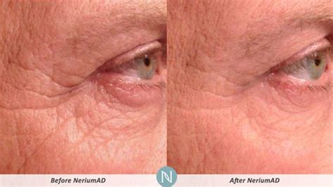 More Real Results With Neriumad