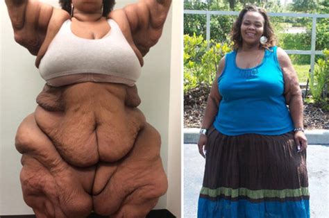 worlds fattest woman loses 32 stone but is left with sagging excess skin daily star