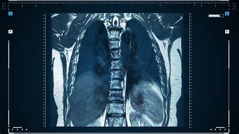 Spinal Muscular Atrophy Complications Rare Disease Advisor