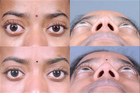 Minimally Invasive Surgery For Thyroid Eye Disease Naik Mn Nair Ag