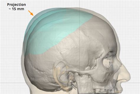 Female Crown Of Skull Augmentation Implant Thickness Side View Dr Barry