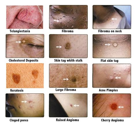 Cherry Angioma Removal Before And After Treating Anigoma Pure Dermatology Whatever You Want