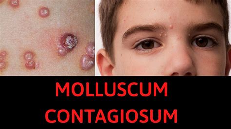 What Is Molluscum Contagiosum Symptoms Treatment Youtube