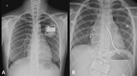 Pacemaker Vs Defibrillator Chest X Ray Sexiezpix Web Porn