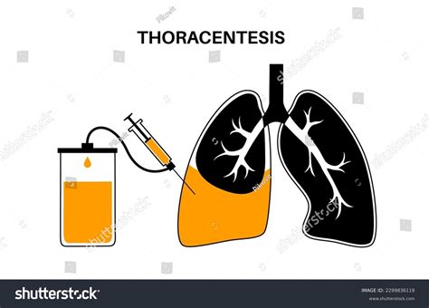 Thoracentesis Procedure Medical Poster Obtain Royalty Free Stock