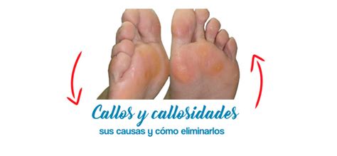 Callos Y Callosidades Sus Causas Y Cómo Eliminarlos Herbi Feet