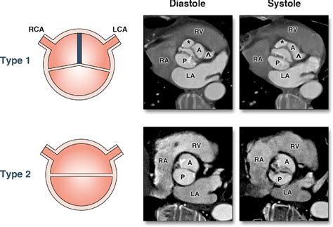 Association Between Bicuspid Aortic Valve Phenotype And Patterns Of Valvular Dysfunction And