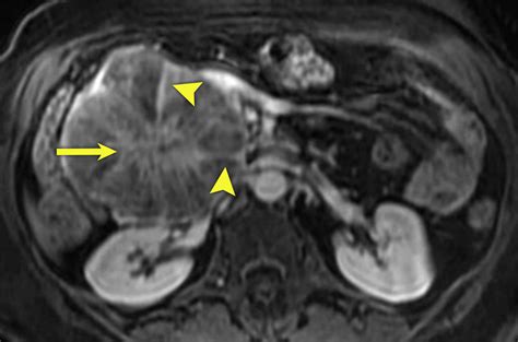 Incidental Pancreatic Cysts On Cross Sectional Imaging Radiology Key