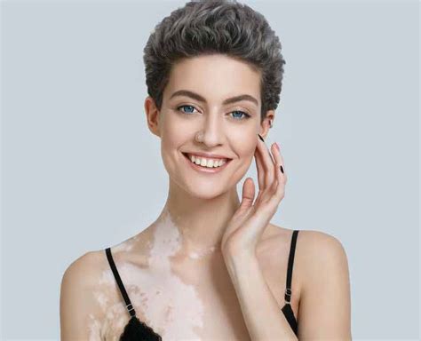World Vitiligo Day 2020 All You Need To Know About Vitiligo And Its