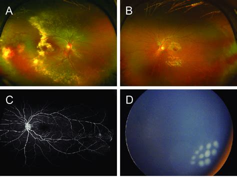 Color Fundus Photography And Fluorescein Angiography Of Patient 3