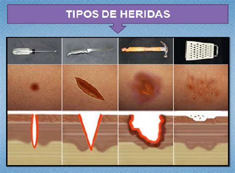 Hemorragias Concepto De Heridas Y Tipos De Heridas The Best Porn Website
