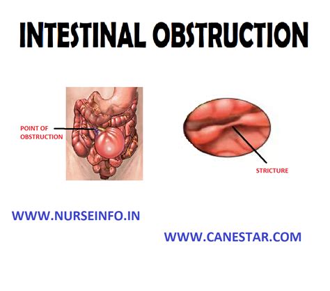 Intestinal Obstruction Nurse Info