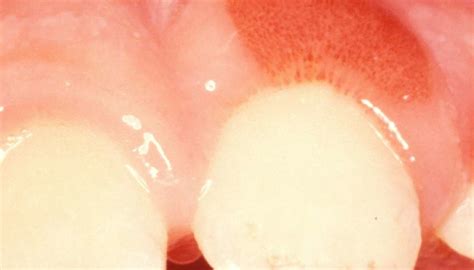 Top 8 Inflamed Gums Around Crown Treatment In 2022 Tuhoangkaido