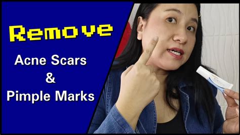How To Remove Acne Scars With Dermatix Acne Scar Gel Youtube