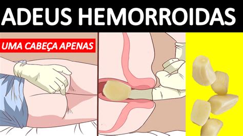 Muitos fatores foram implicados no desenvolvimento da doença hemorroidária, incluindo o esforço defecatório excessivo, pressão. Tratamento CASEIRO Para HEMORROIDAS INTERNAS - VEJA Os ...