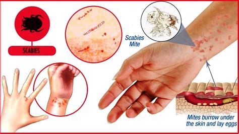 Scabies Itch Rash Homeopathictreatment