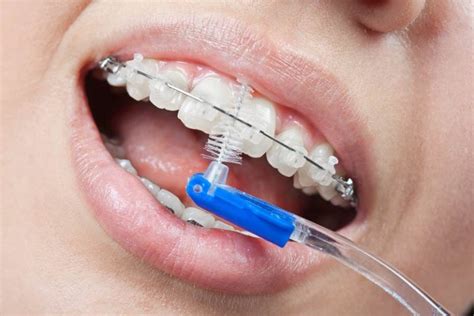 Finding The Best Toothbrush For Braces News Dentagama