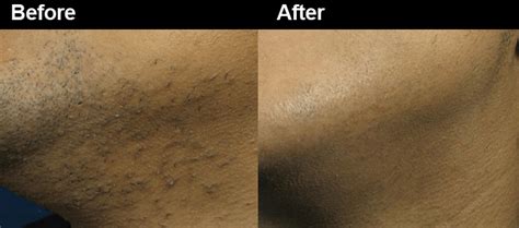 He is also the husband of our. Facial Laser Hair Removal | Laser Hair Removal for Face ...