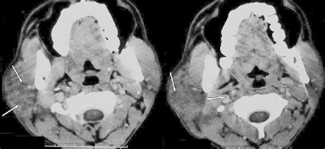 Contrast Enhanced Ct Neck Showed Enlarged Right Parotid Gland With