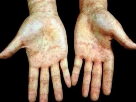 梅毒の初期症状・治療法湿疹のような皮膚症状で気づくことも 皮膚・爪・髪の病気 All About