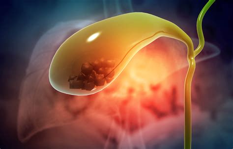 Can Gallbladder Stones Cause Cancer Roswell Park Comprehensive