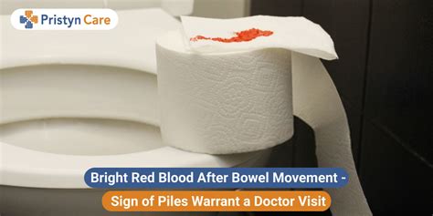 Bright Red Blood In Stool Diverticulitis Diverticular Bleeding Cigna