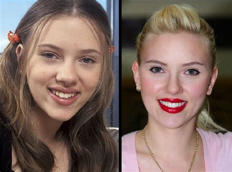 Scarlett Johansson Before And After Plastic Surgery
