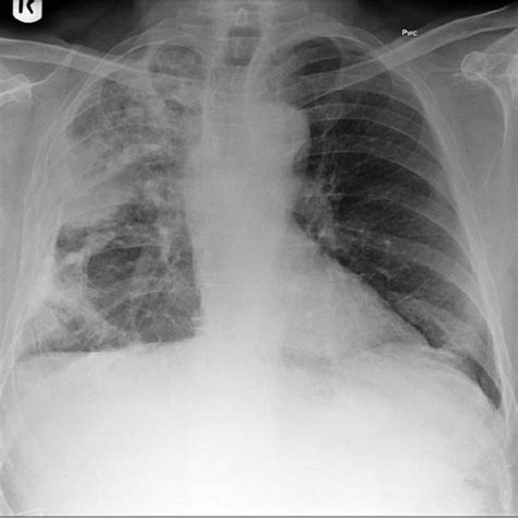 A Chest Radiograph Showing Calcified Metastases From An Osteogenic