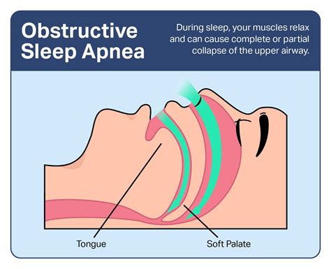 Obstructive Sleep Apnea Symptoms Causes And Treatments Sleep