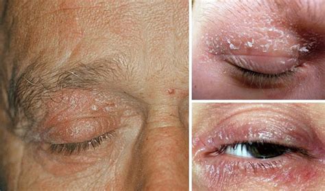 Psoriasis On The Eyelids Causes Symptoms And Treatment Psoriasis Expert