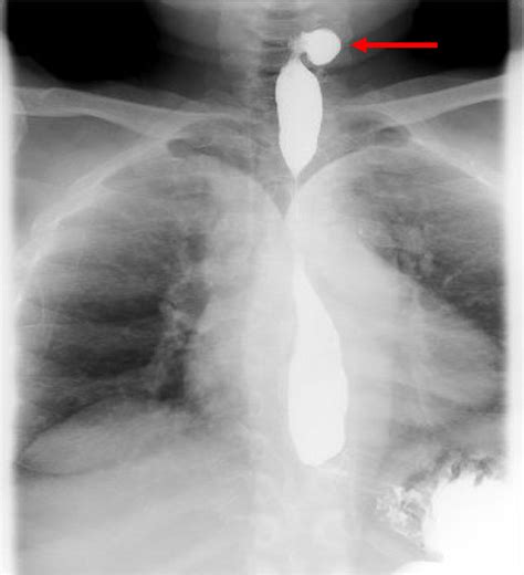 Cureus Killian Jamieson Diverticulum A Rare Cause Of Dysphagia