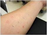 Pictures of What Doctor Does Allergy Testing
