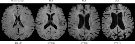 The Measurement And Clinical Relevance Of Brain Atrophy In Multiple